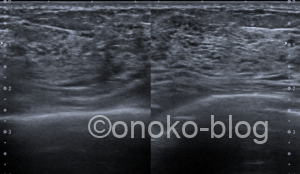 妊娠期乳腺超音波