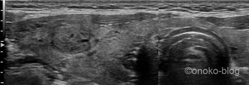 甲状腺髄様癌症例①