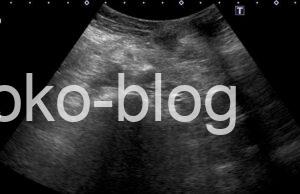 腹壁瘢痕ヘルニアのエコー画像です