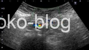 腹壁瘢痕ヘルニアのエコー画像です