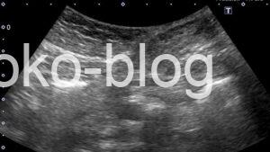 腹壁瘢痕ヘルニアのエコー画像です