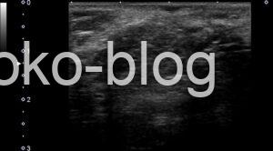 腹壁瘢痕ヘルニアのエコー画像です