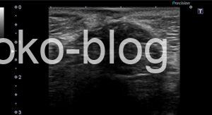 腹壁瘢痕ヘルニアのエコー画像です