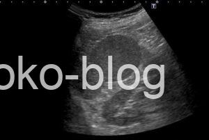 脾過誤腫疑いのエコー画像