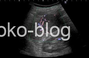 脾過誤腫疑いのエコー画像カラードプラバスケットパターンのように見えます