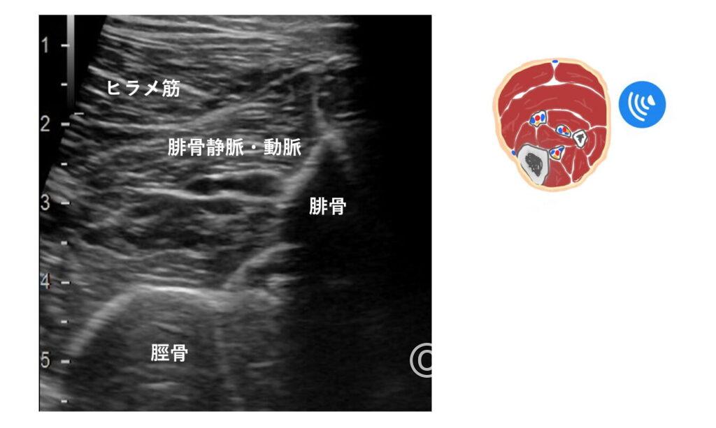 腓骨・腓骨静脈・動脈のエコー画像