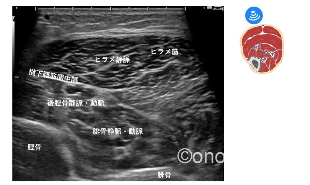 横下腿筋間中隔と後脛骨静脈・動脈のエコー画像